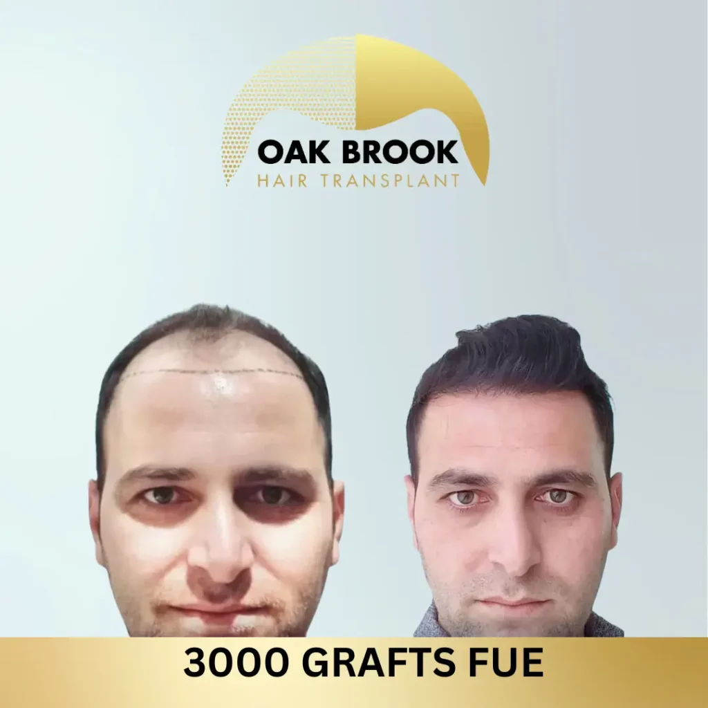 Oak Brook Hair Transplant 3000 grafts FUE