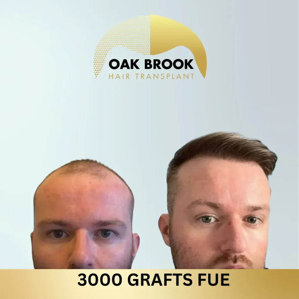 Oak Brook Hair Transplant 3000 grafts FUE