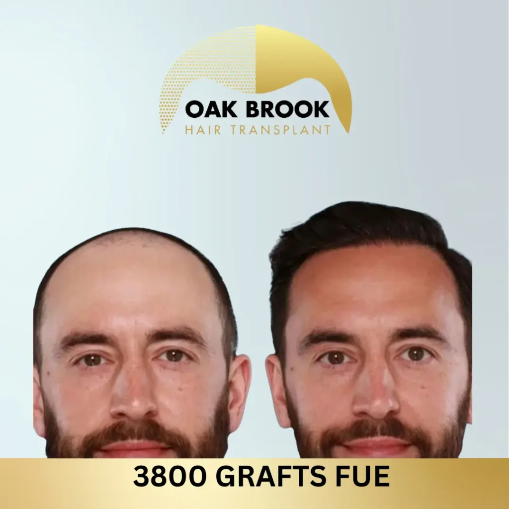 Oak Brook Hair Transplant 3800 grafts FUE