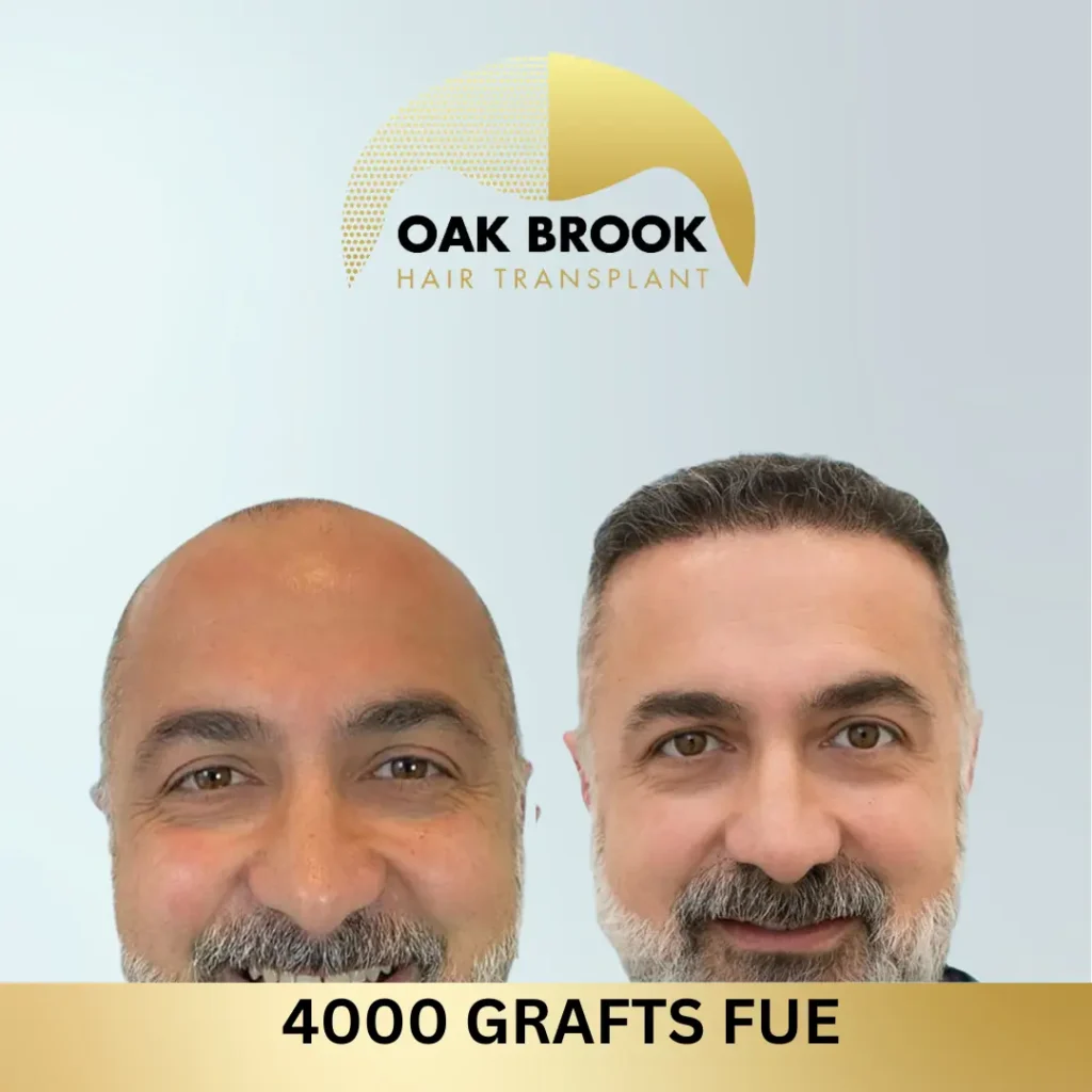 Oak Brook Hair Transplant 4000 grafts FUE