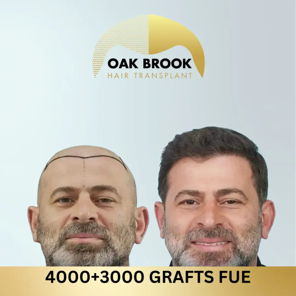 Oak Brook Hair Transplant 4000+3000 grafts FUE