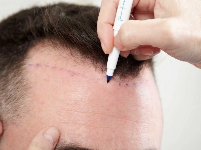 Non-Surgical Hair Restoration Explained