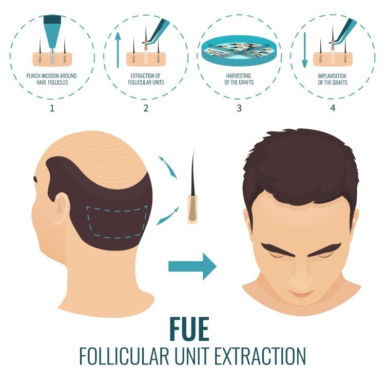 Follicular Unit Extraction