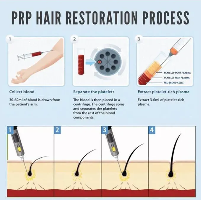 PRP Hair Restoration Process