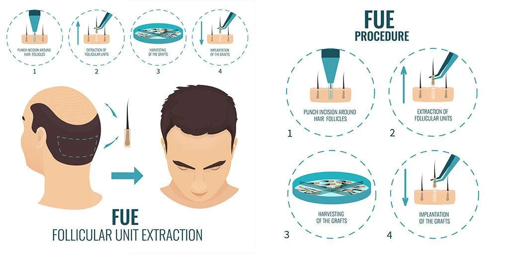 FUE PROCEDURE
