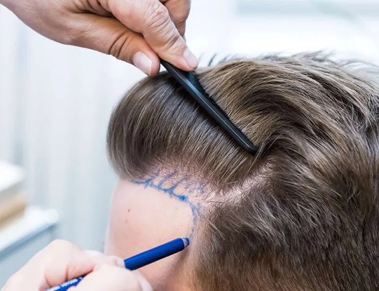 Non-Surgical Hair Restoration