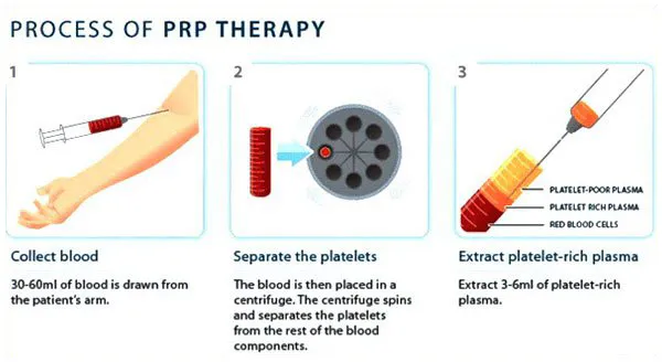 Process of PRP Therapy