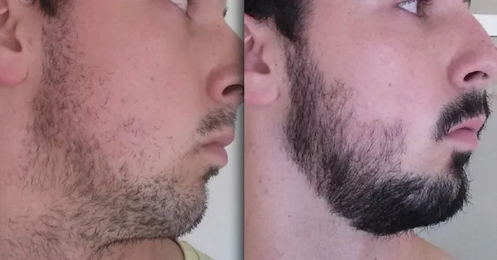 Beard Growth