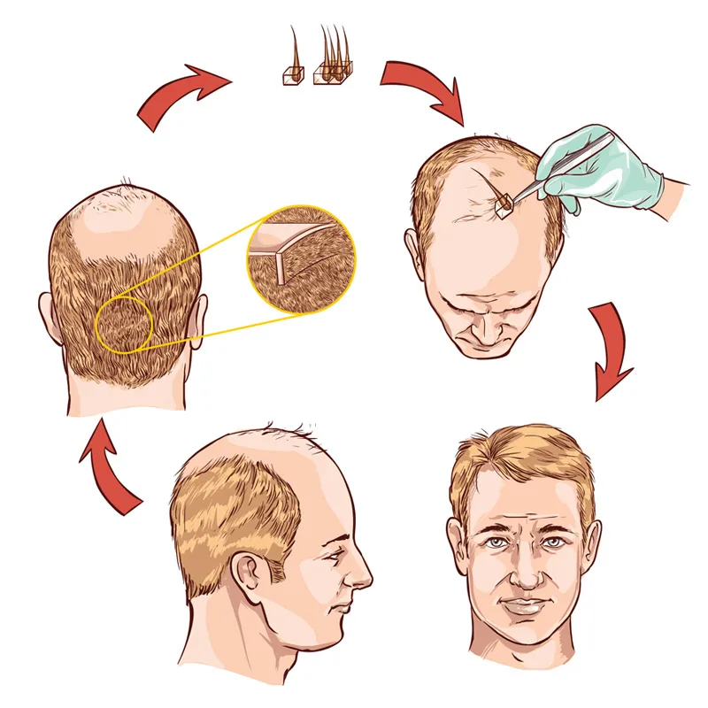 fue hair transplant