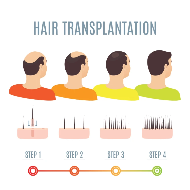hair transplantation surgery steps