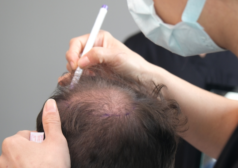 Permanent Hair Restoration What You Need