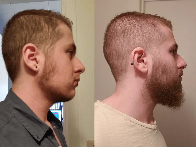 Before and after beard treatment