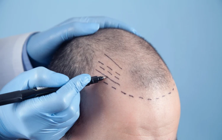 Hair Marking for Restoration