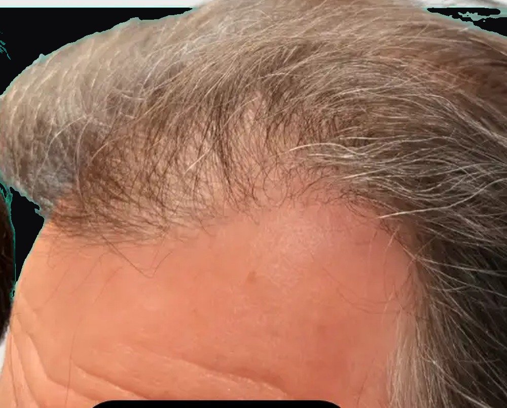 The same patient after treatment