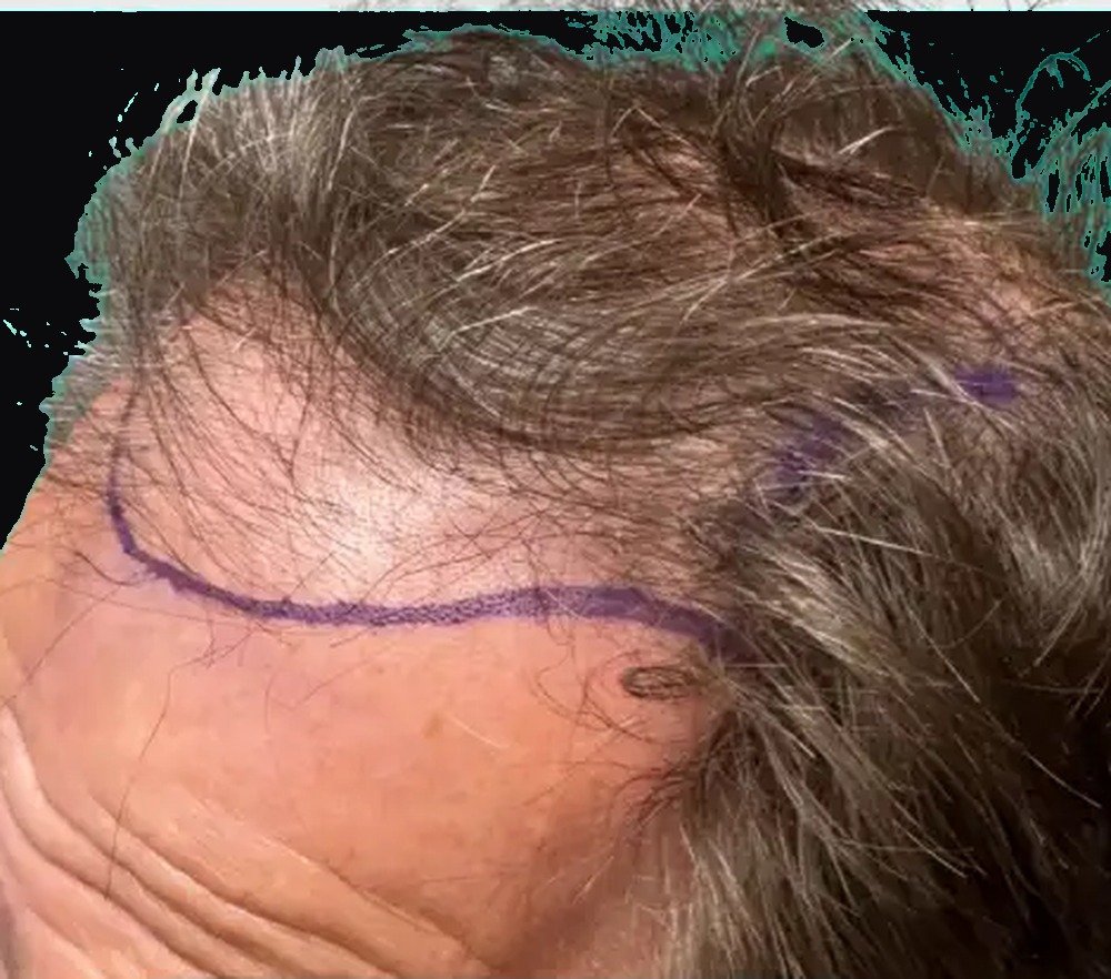 Hair restoration patient before treatment