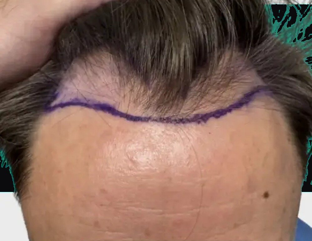 Hair restoration patient before treatment