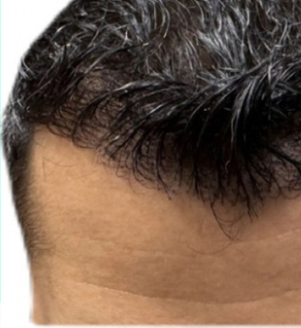 The same patient after treatment