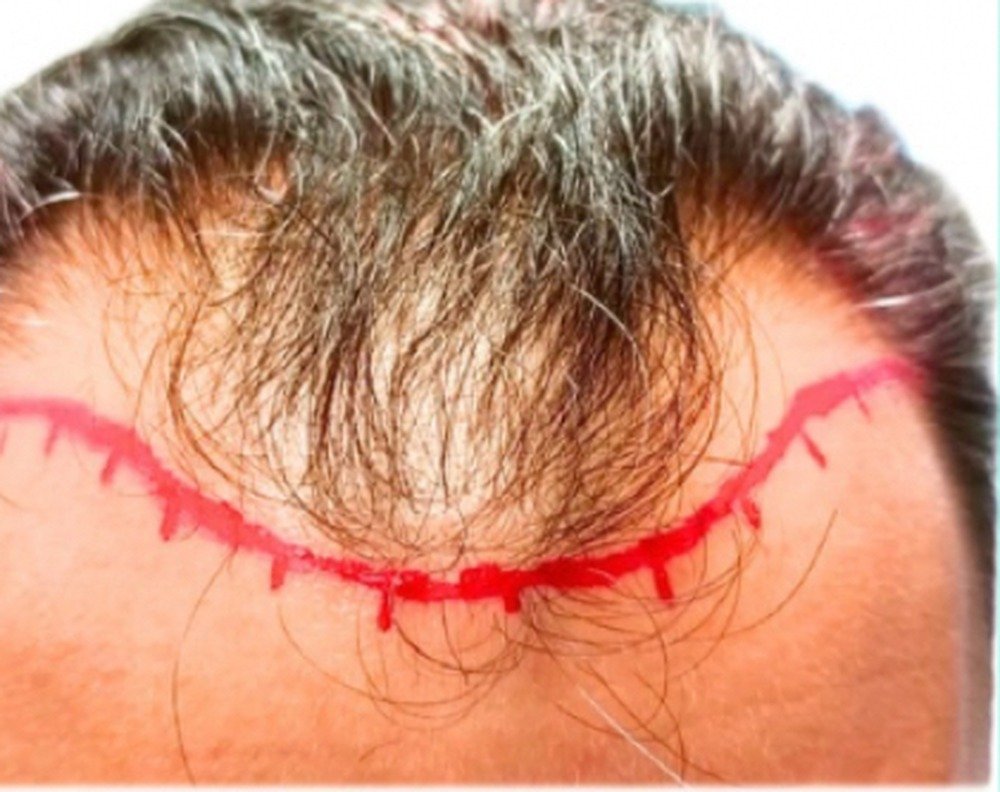 Hair restoration patient before treatment