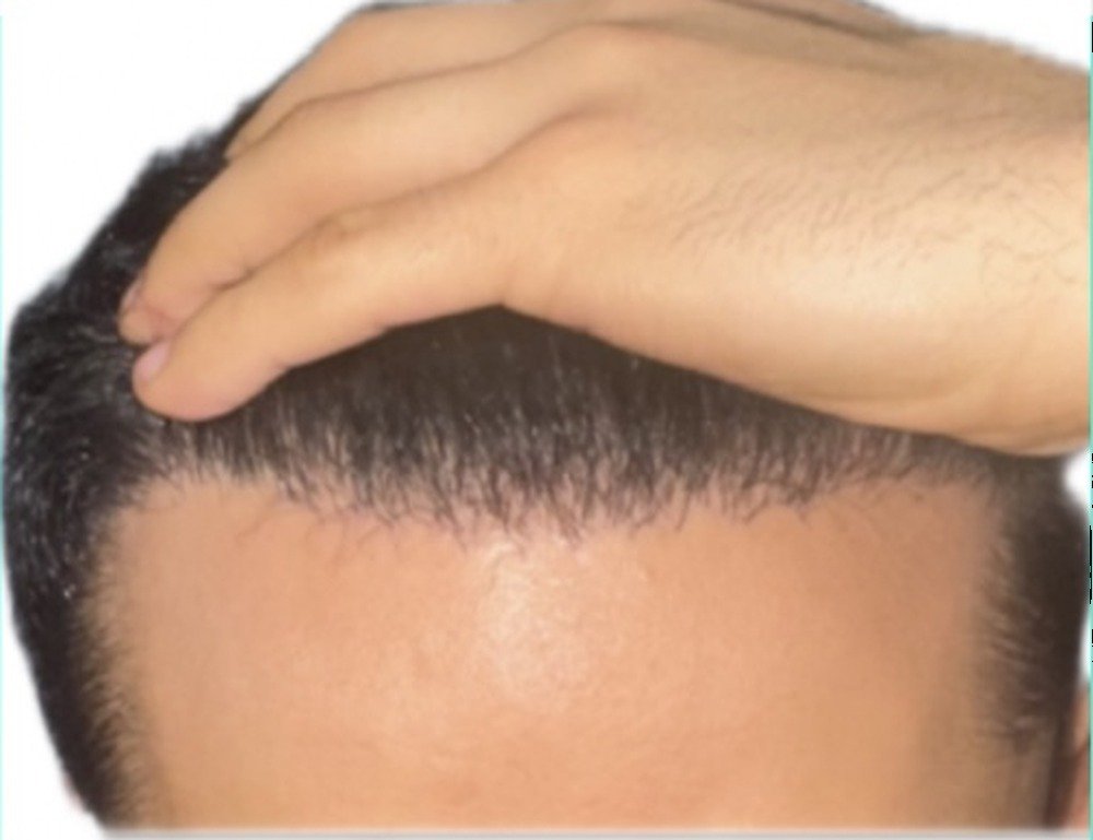 The same hair restoration patient after treatment