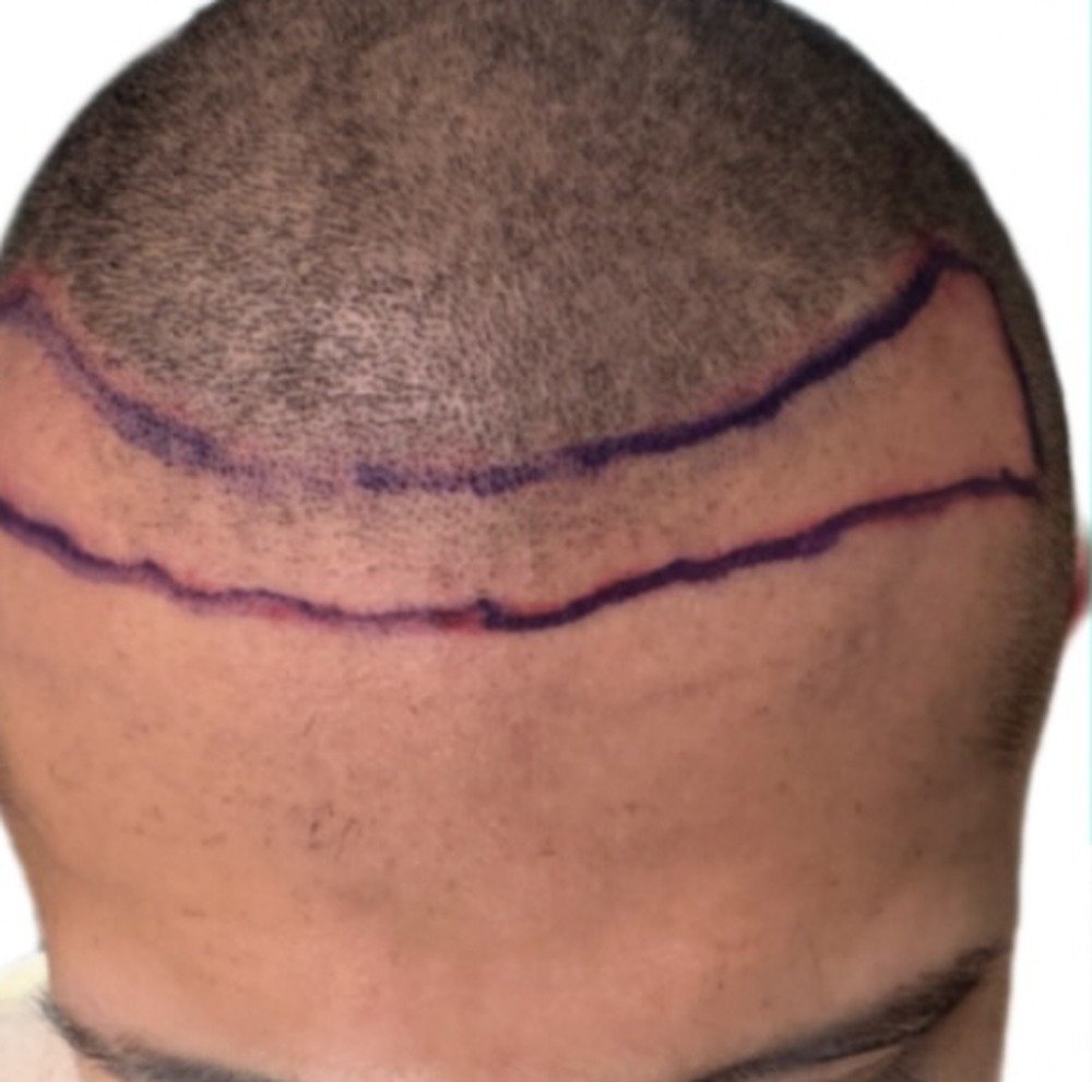 Hair restoration patient before treatment