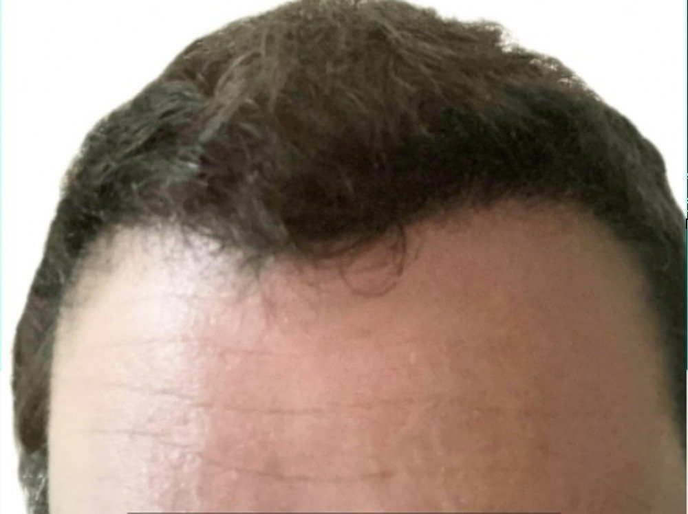 The same hair restoration patient after treatment