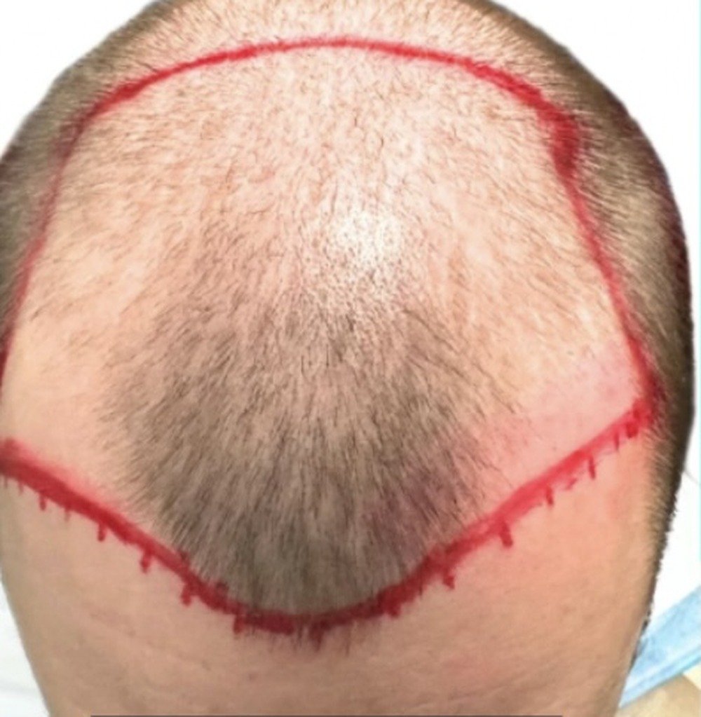 Hair restoration patient before treatment, with surgical hairline design marked