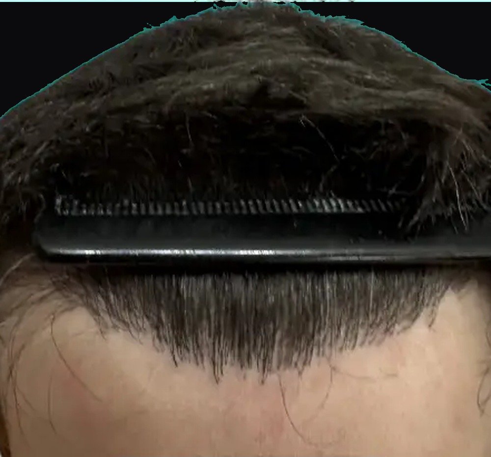 The same patient after treatment