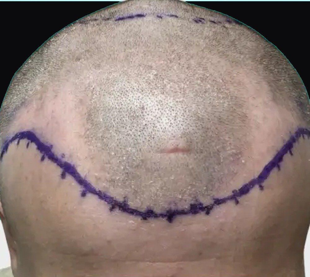 Hair restoration patient before treatment