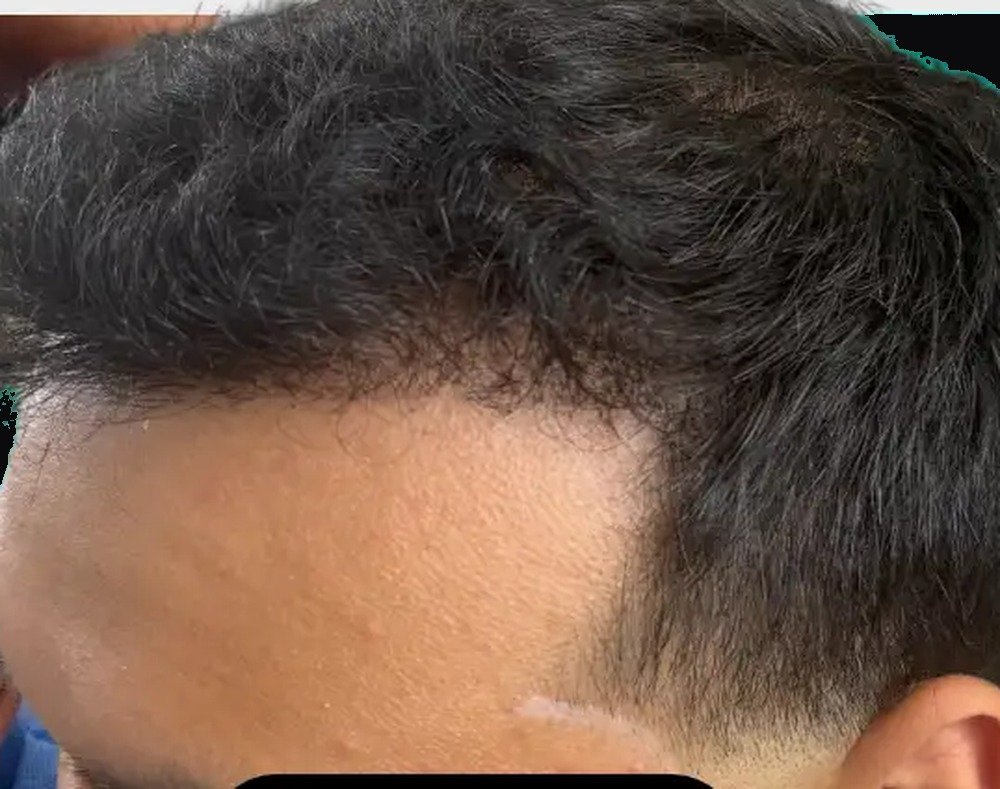 The same hair restoration patient after treatment