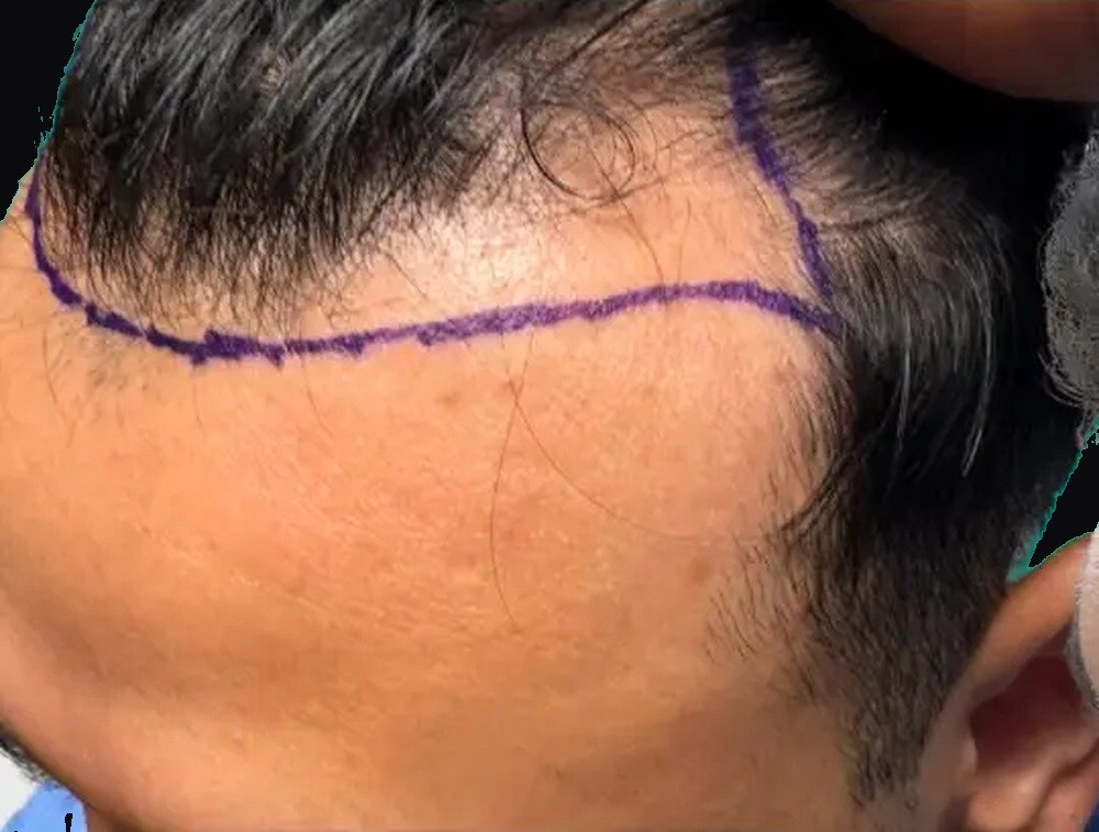 Hair restoration patient before treatment, with surgical hairline design marked