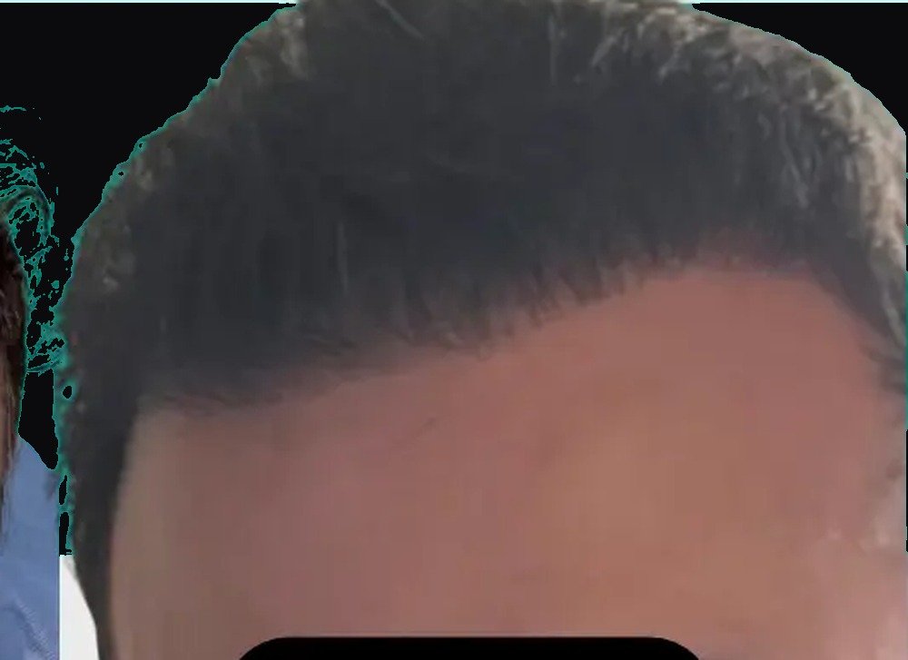 The same hair restoration patient after treatment