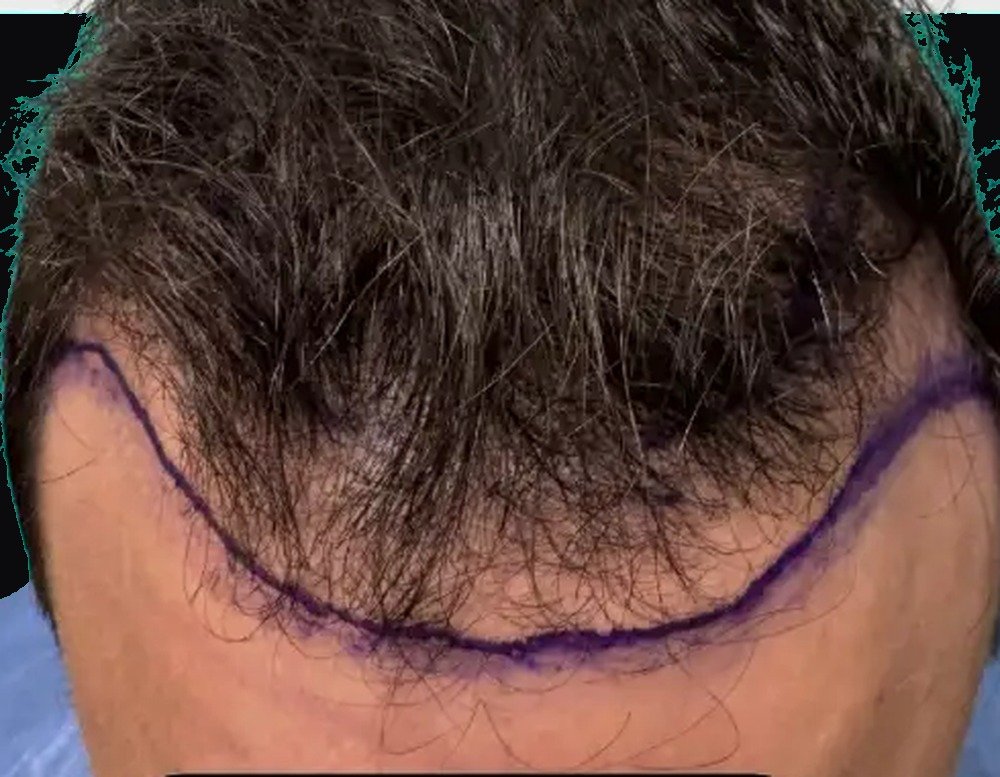 Hair restoration patient before treatment