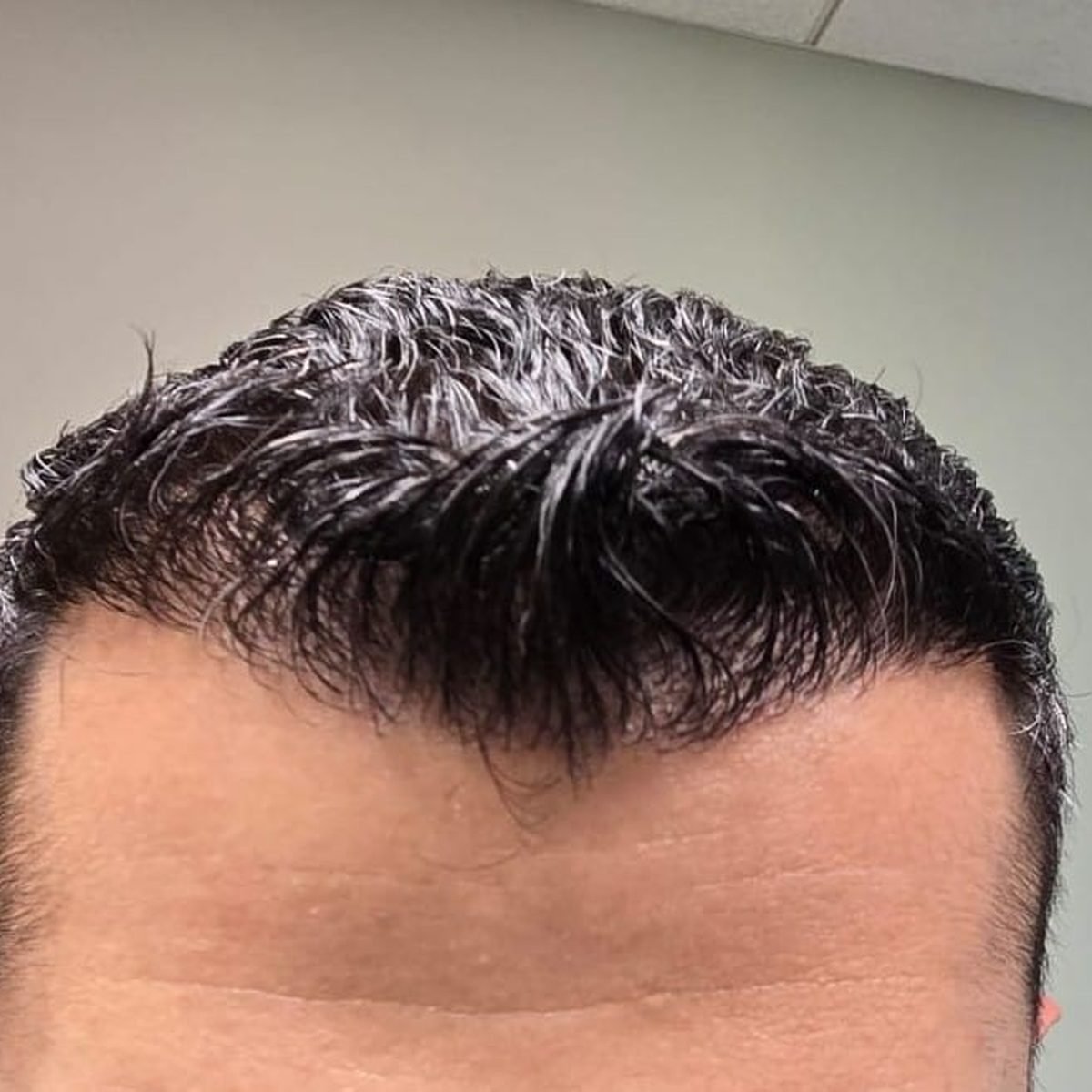 The same patient after FUE hair restoration, frontal hairline