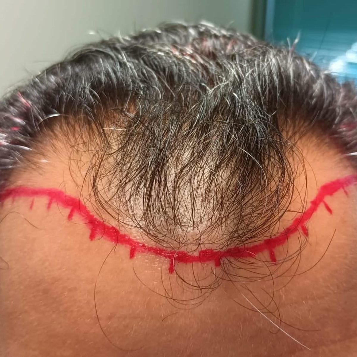 Patient before FUE hair restoration at Oak Brook Hair Transplant, frontal hairline, hairline marked for surgery