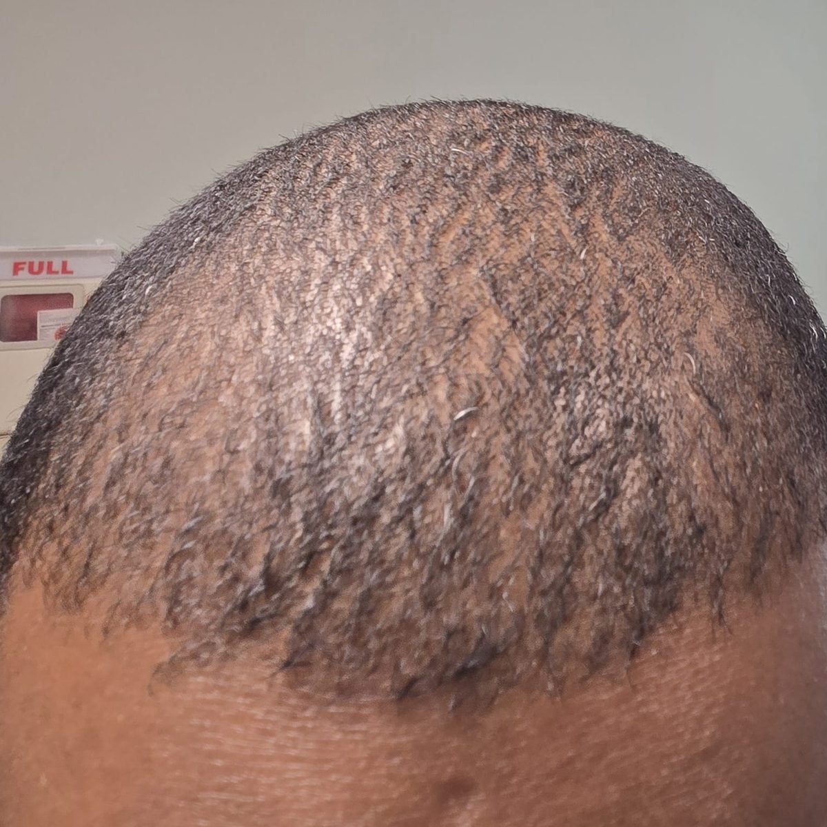 The same patient one year after FUE hair restoration, frontal hairline