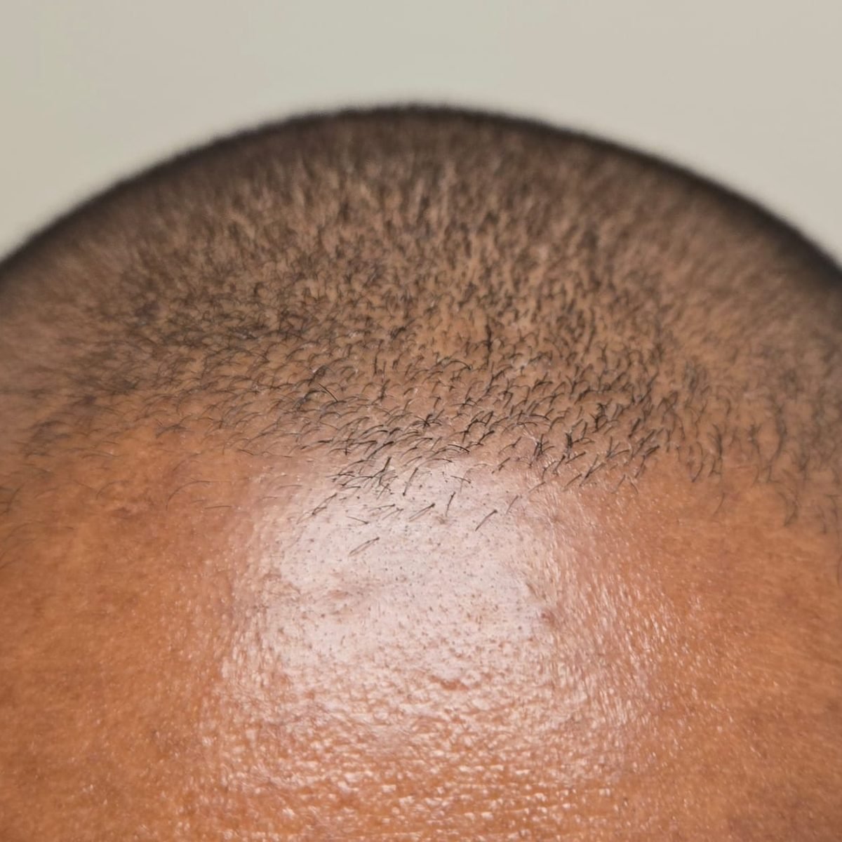 Patient before FUE hair restoration at Oak Brook Hair Transplant, frontal hairline