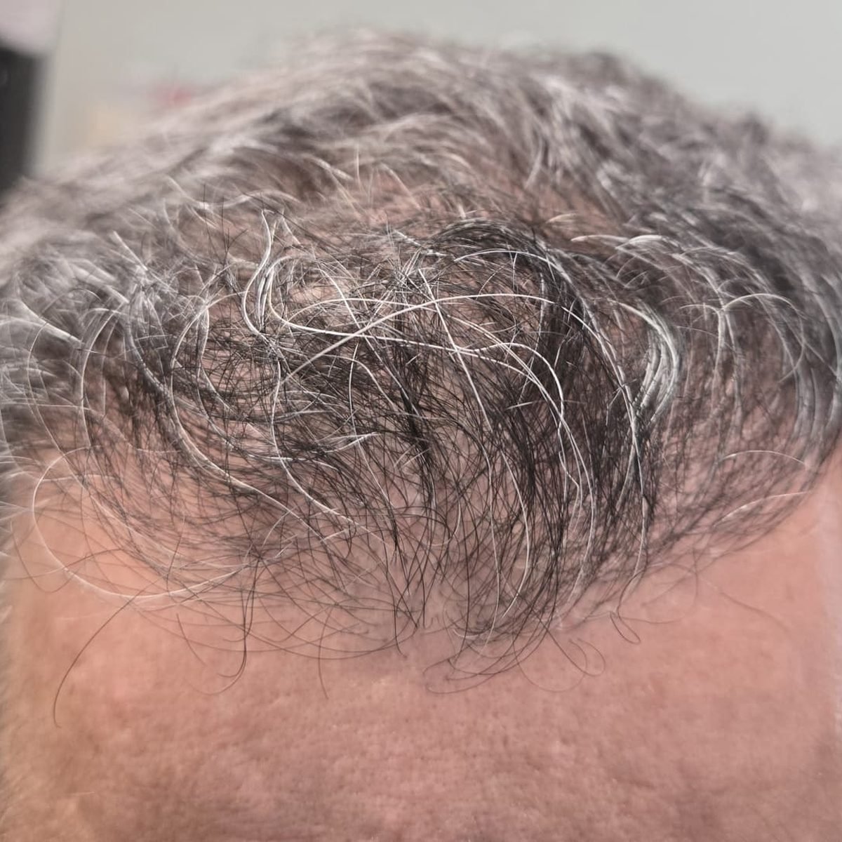 The same patient one year after FUE hair restoration with 2,000 grafts, frontal hairline