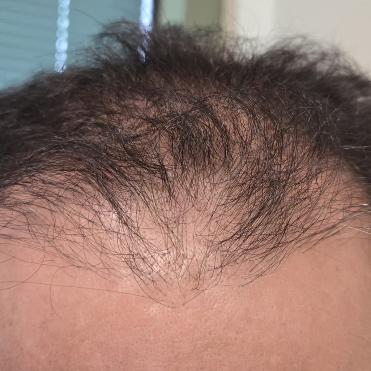 Patient before FUE hair restoration at Oak Brook Hair Transplant, frontal hairline