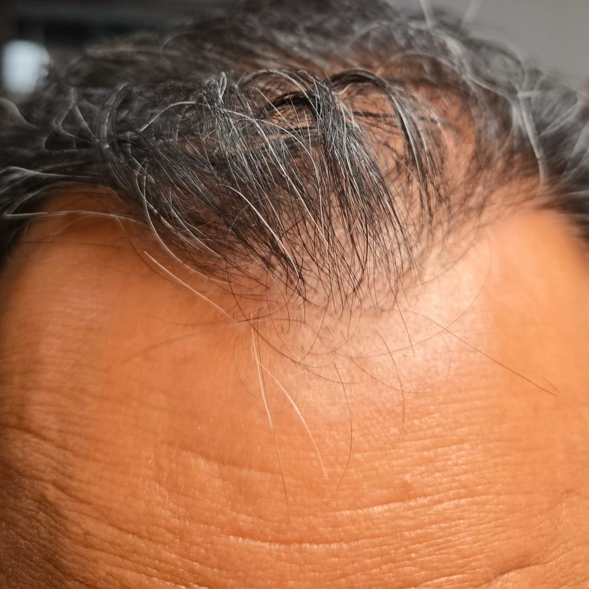 The same patient eight months after FUE hair restoration with 3,000 grafts, frontal hairline