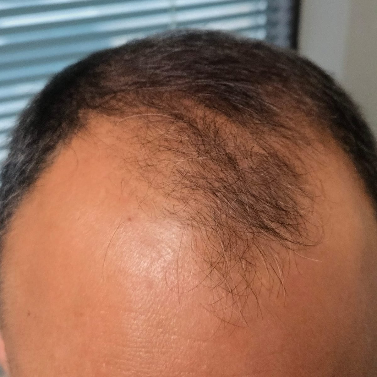 Patient before FUE hair restoration at Oak Brook Hair Transplant, frontal hairline