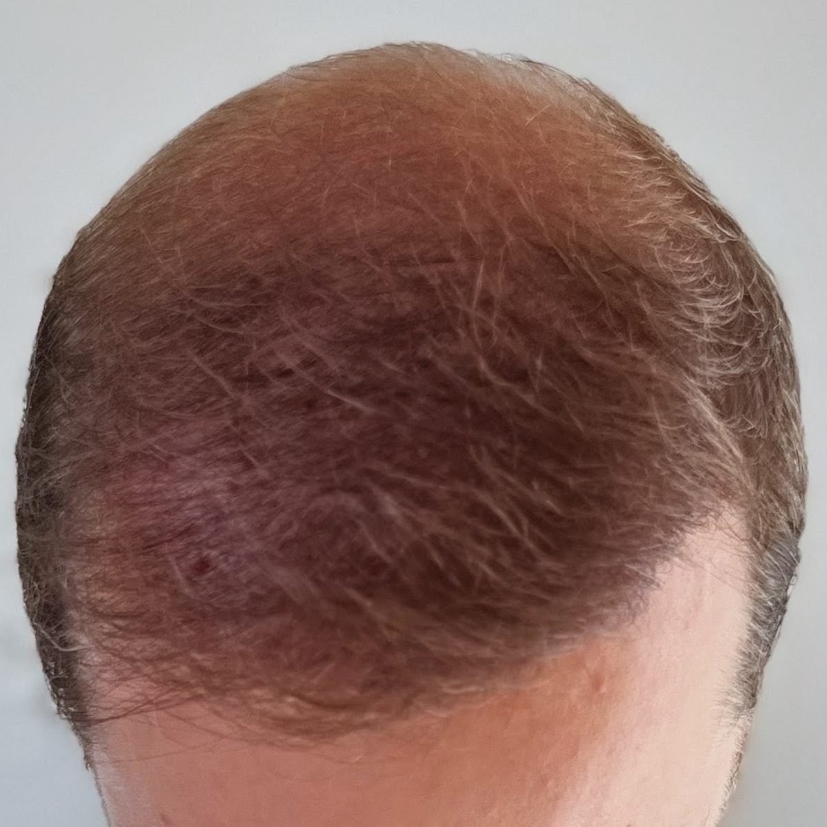 The same patient six months after FUE hair restoration with 3,000 grafts, top and frontal view