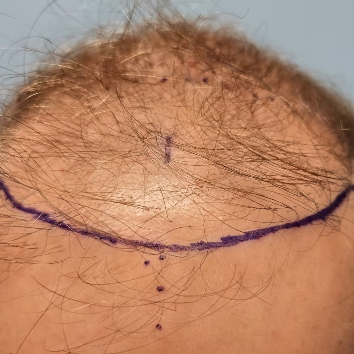 Patient before FUE hair restoration at Oak Brook Hair Transplant, top and frontal view, hairline marked for surgery
