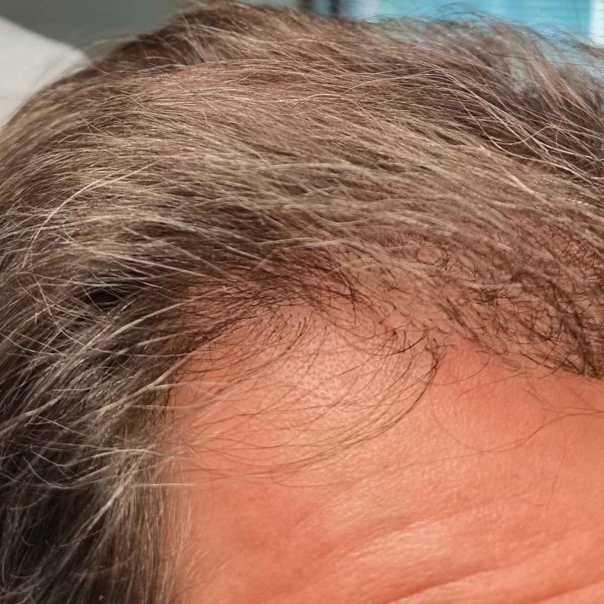 The same patient six months after FUE hair restoration with 3,000 grafts, oblique hairline