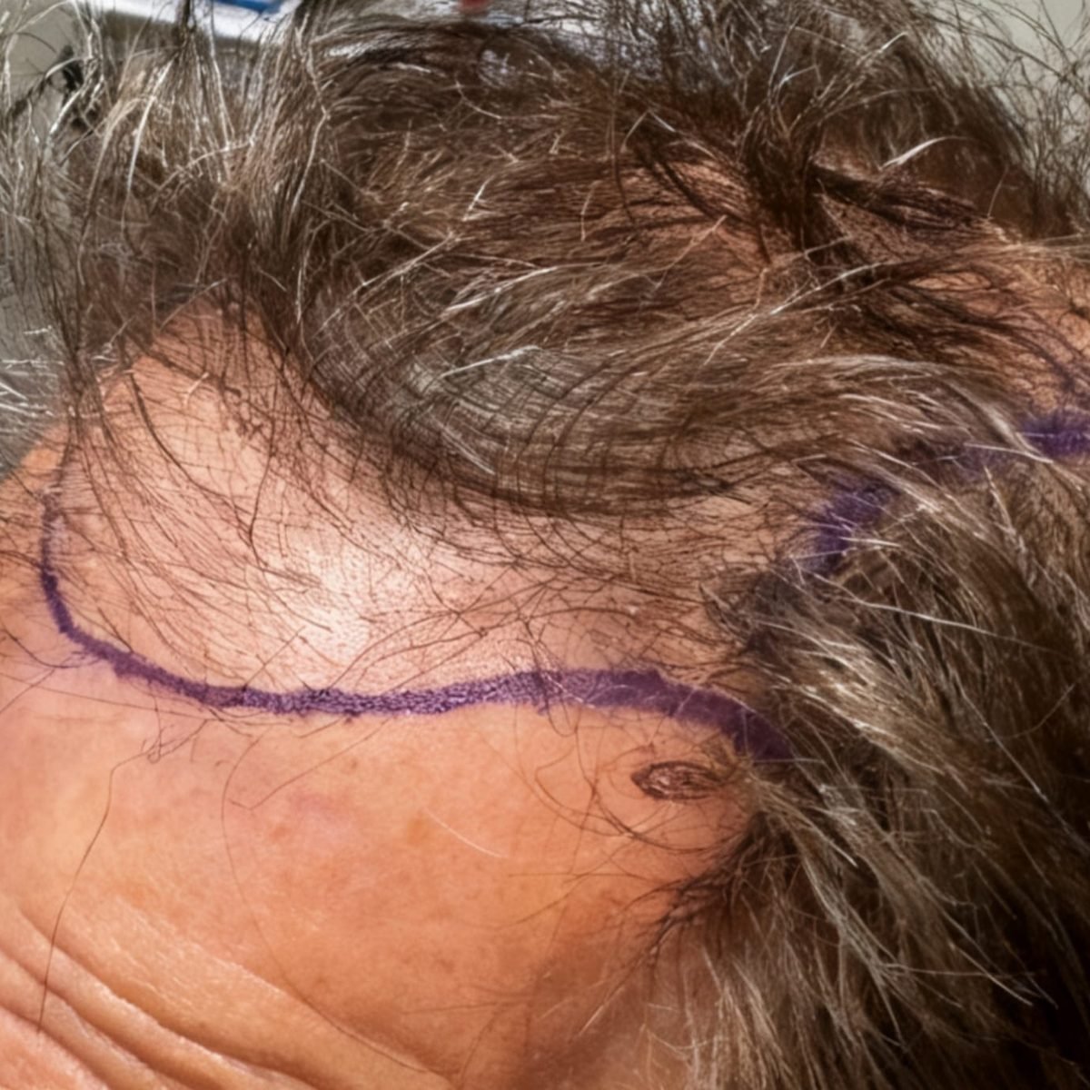 Patient before FUE hair restoration at Oak Brook Hair Transplant, oblique hairline, hairline marked for surgery