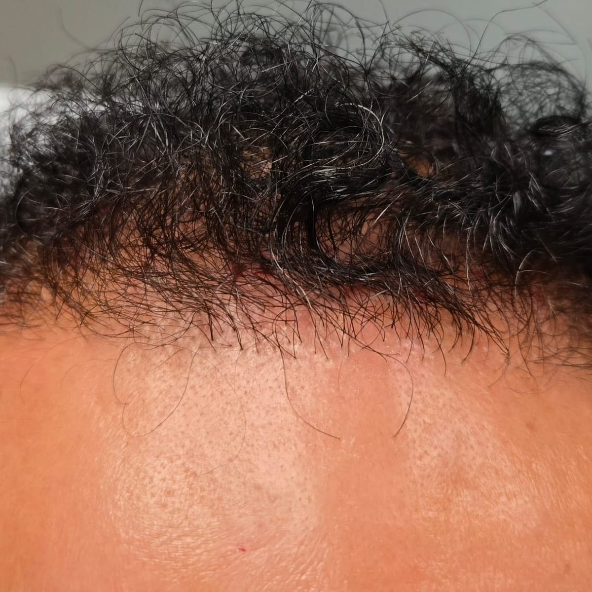 The same patient six months after FUE hair restoration with 3,000 grafts, frontal hairline