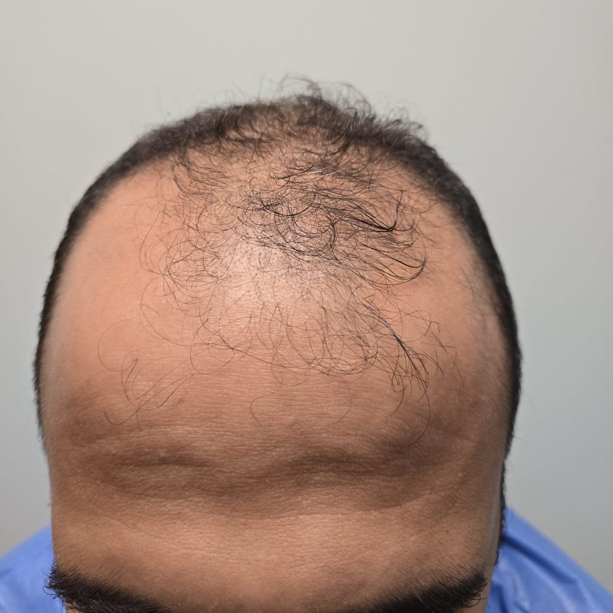 Patient before FUE hair restoration at Oak Brook Hair Transplant, frontal hairline