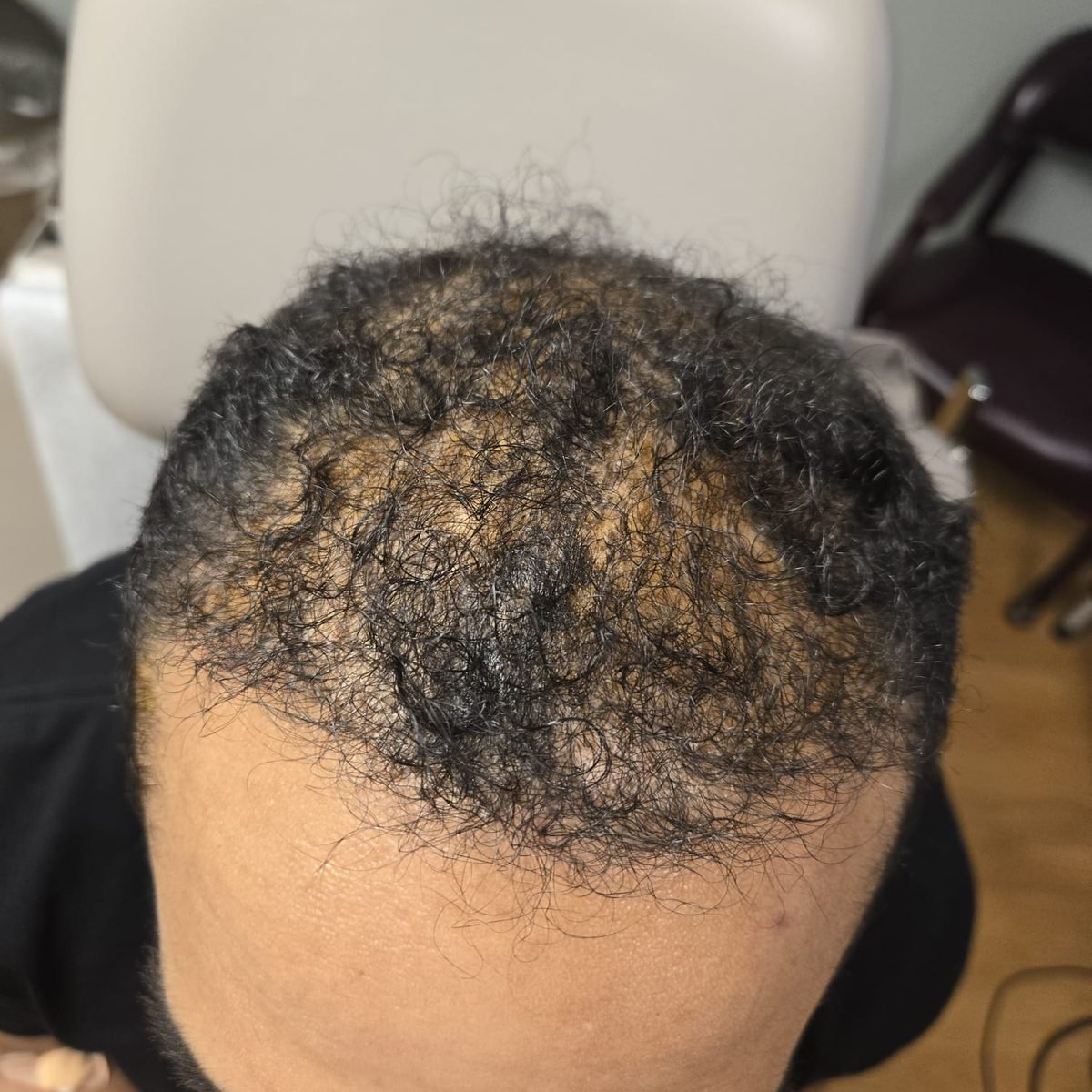 The same patient six months after FUE hair restoration with 3,000 grafts, top and frontal view