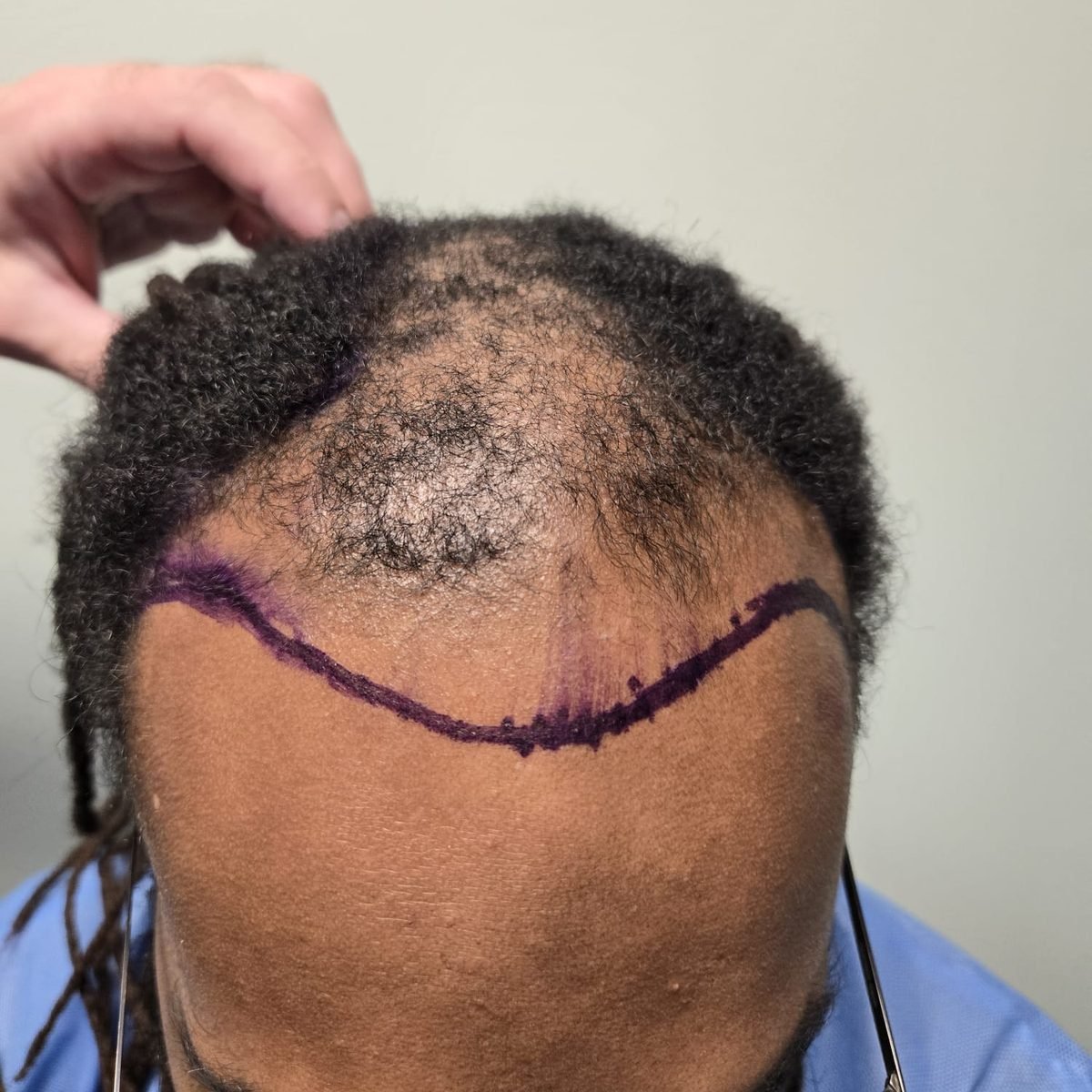 Patient before FUE hair restoration at Oak Brook Hair Transplant, top and frontal view, hairline marked for surgery
