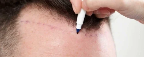 Non-Surgical Hair Restoration Explained