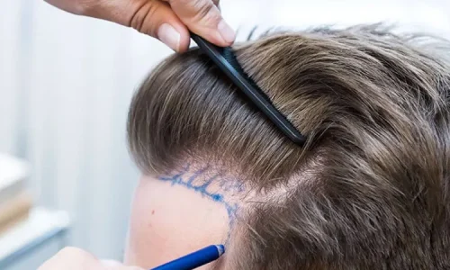 Non-Surgical Hair Restoration